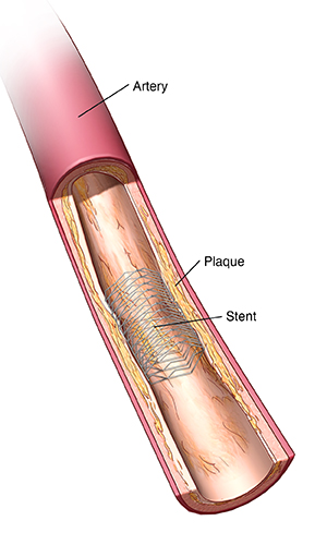 Partial cross section of artery showing stent holding artery open.