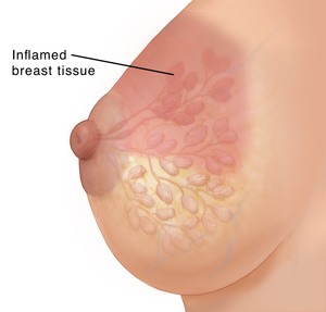 Side view of female breast with ducts and lobules ghosted in, showing inflamed skin and glands.