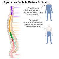 Ilustración de lesiones agudas de la médula espinal que pueden resultar en una tetraplejia o en una paraplejia