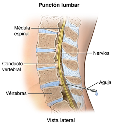 Vista lateral de corte transversal de la columna vertebral lumbar donde se observa una punción lumbar.